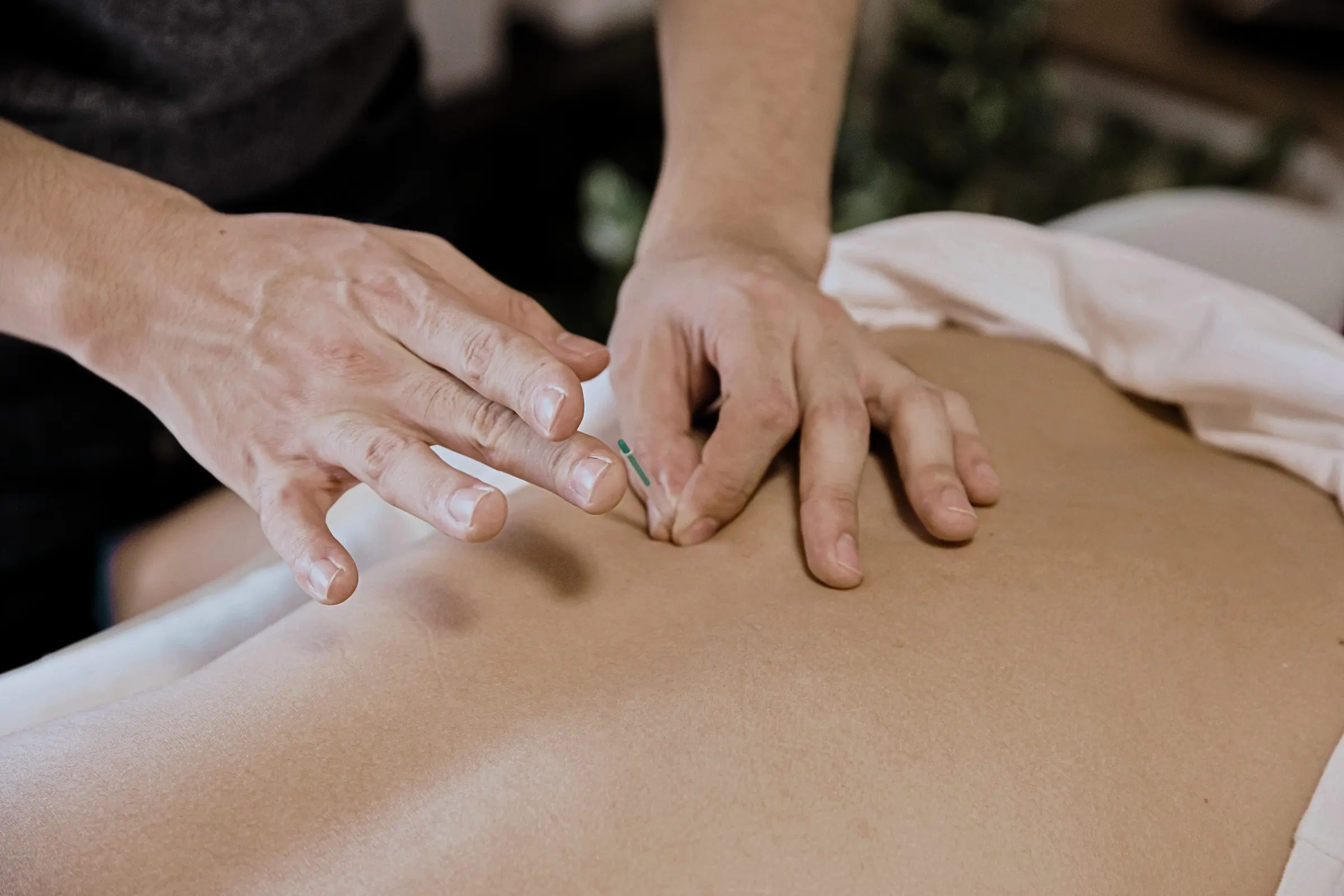 Medical Acupuncture